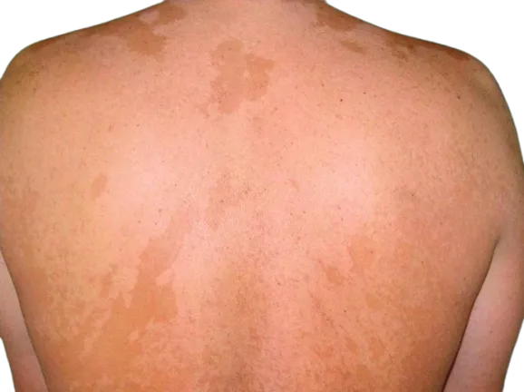 Skin infections (bacterial/viral)